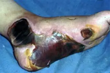 Diyabet Yaraları Belirtileri ve Tedavisi